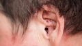 Kulak İçi Soyulması, Nedenleri ve Tedavisi